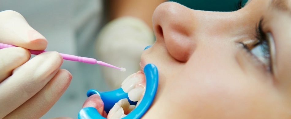 Детская стоматология: Фторирование зубов